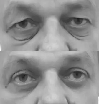 blepharoplasty before/after photo