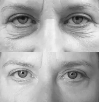eyelid surgery photos before and after