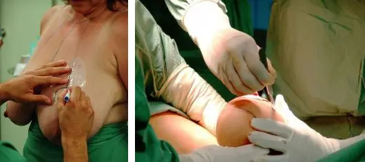 zmenšení prsou s modelací