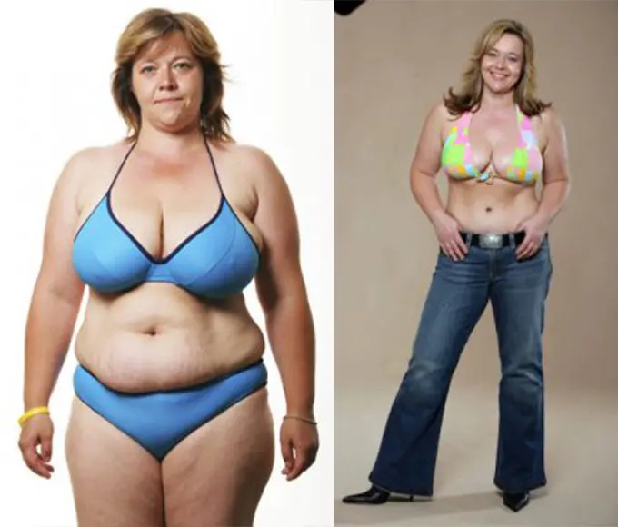 Abdominoplastyka + liposukcja + zmniejszenie piersi