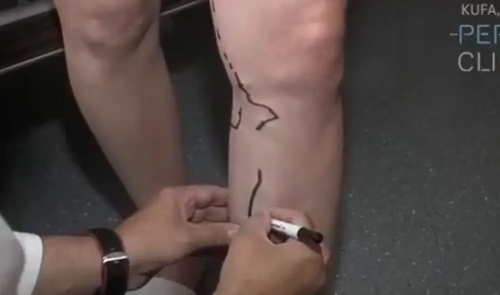 Лечение варикозного расширения вен лазером