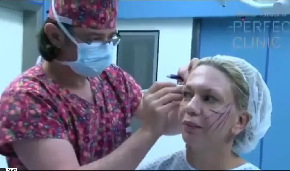 Silhouette - малоинвазивная пластическая операция лица