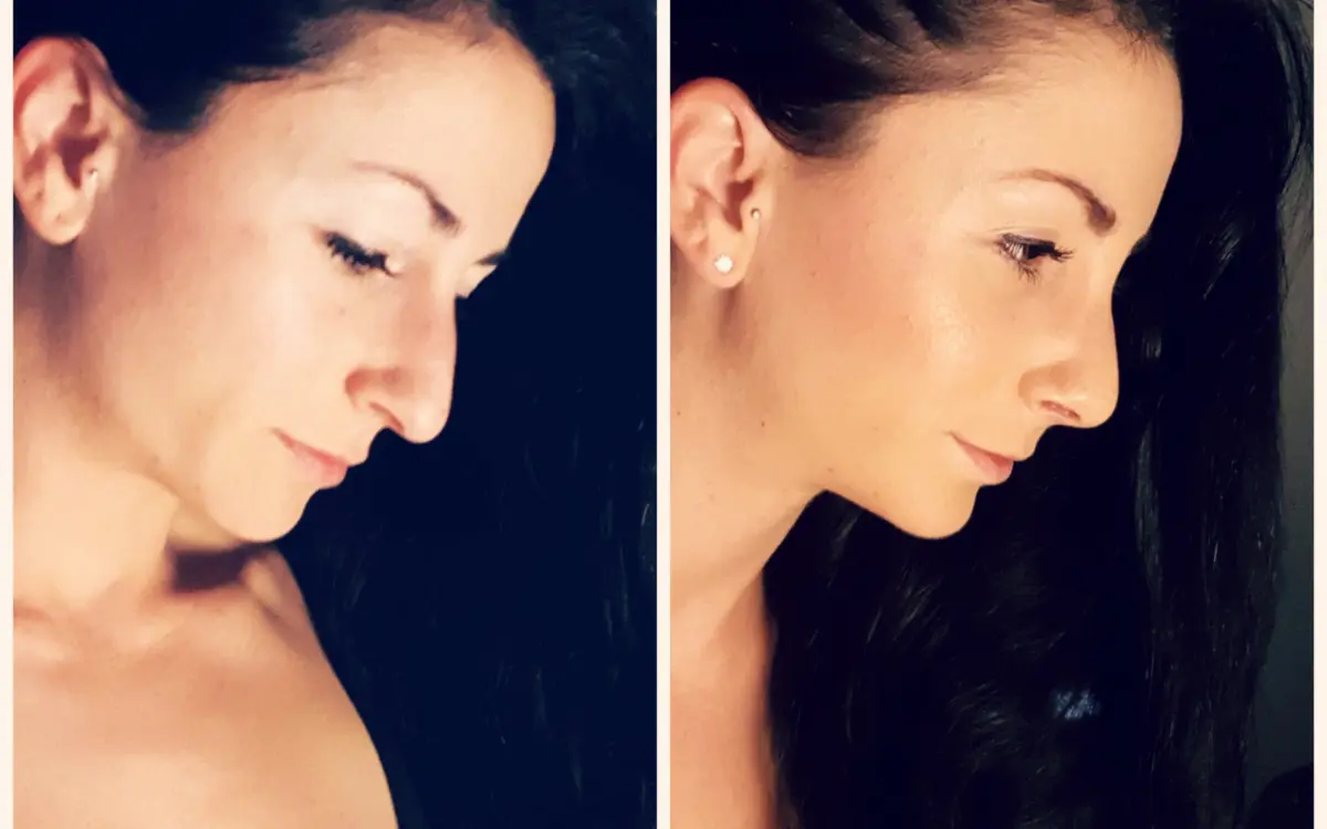 Janine Lewis und ihre Nasenkorrektur