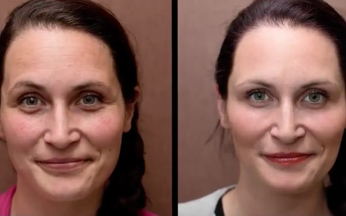 Anti-aging przemiany - Mezoterapia okolicy oczu, wampirzy lifting a powiększania ust