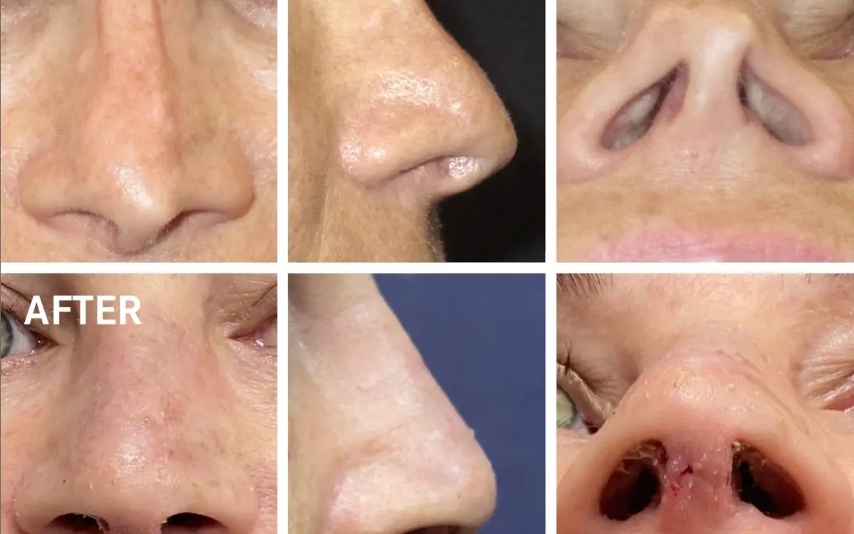 Sekund&auml;re&nbsp;Rhinoplastik - Dr. med. Roman Kufa