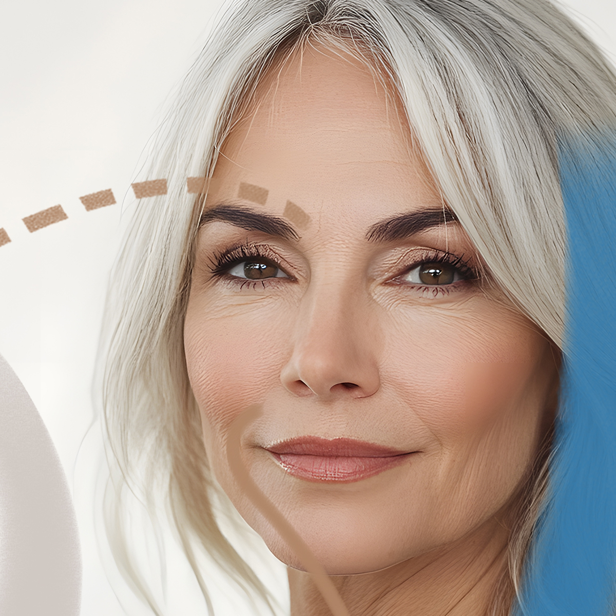 Browlift