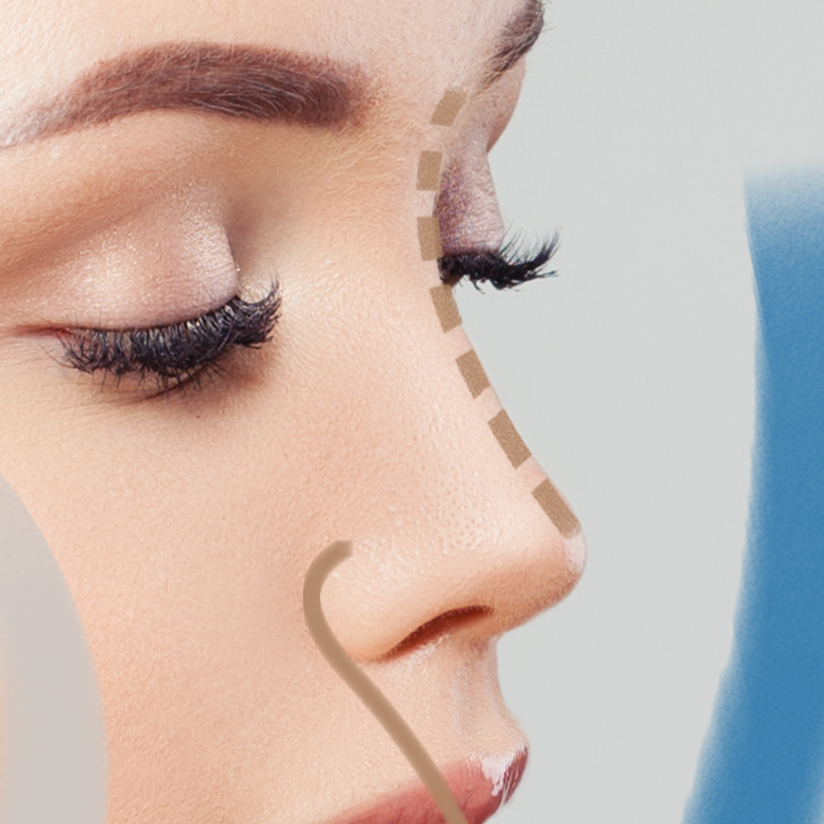 Rhinoplastika. Plastická operace nosu . Vadí vám tvar nebo velikost nosu, nebo máte problémy s dýcháním? Svěřte se do rukou odborníků z Perfect Clinic, kteří vám pomohou problém vyřešit.