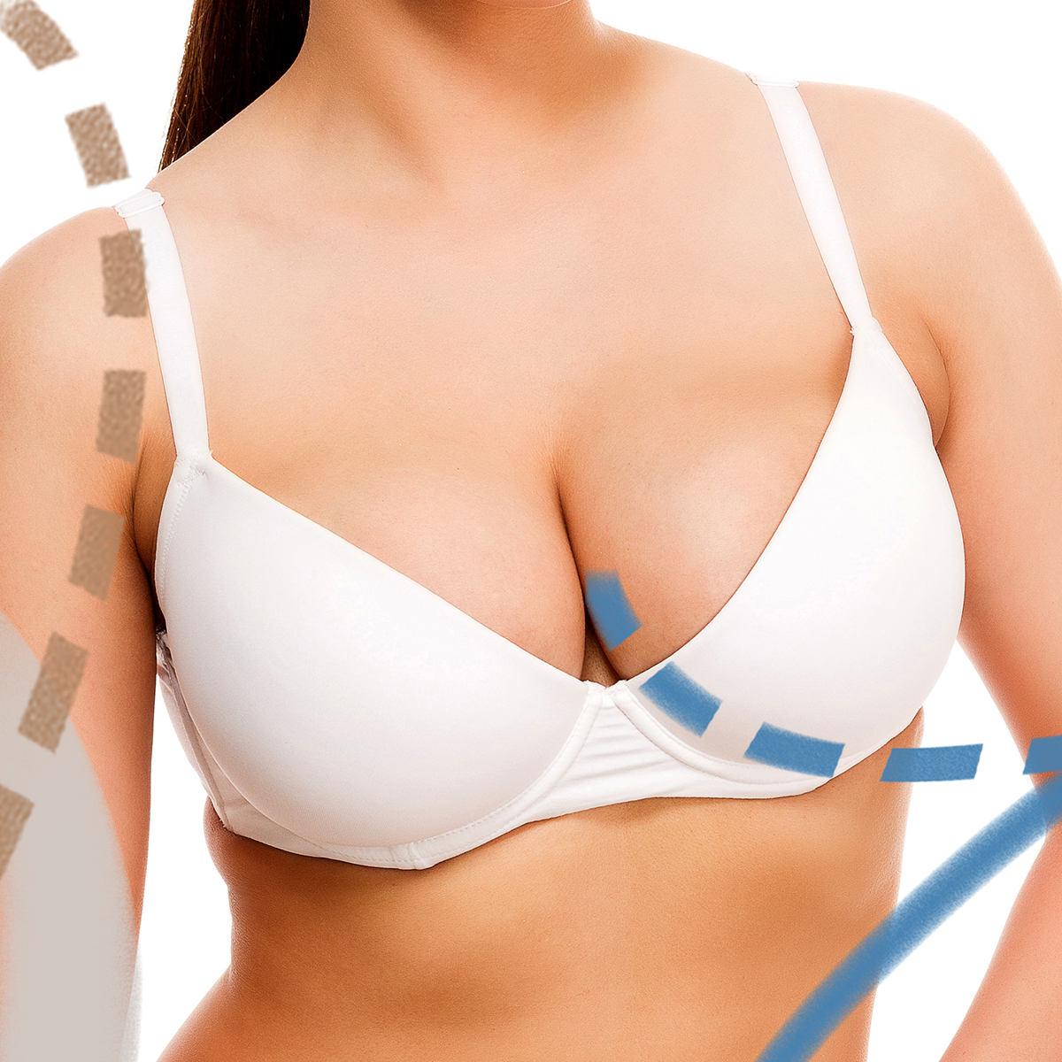 Zmenšení prsou v Perfect Clinic. Redukční mammaplastika. Svěřte se do rukou odborníků z Perfect Clinic, kteří vám pomohou problém vyřešit.