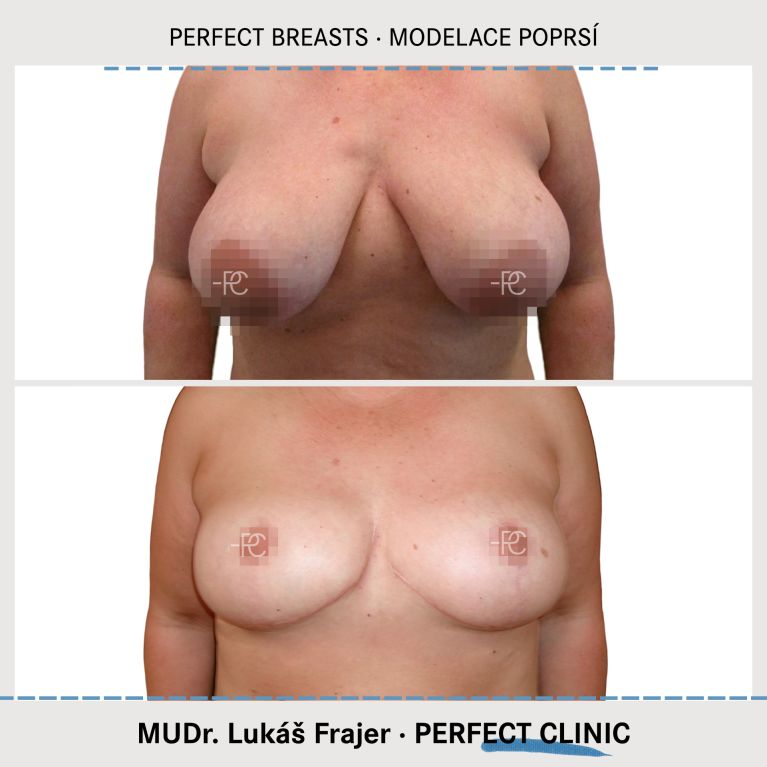 Modelace prsou