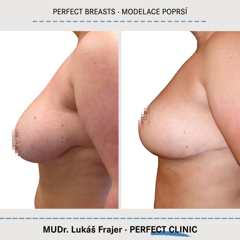 Modelace prsou