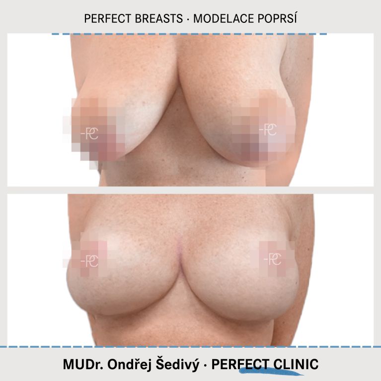Modelace prsou