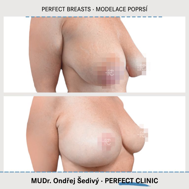 Modelace prsou