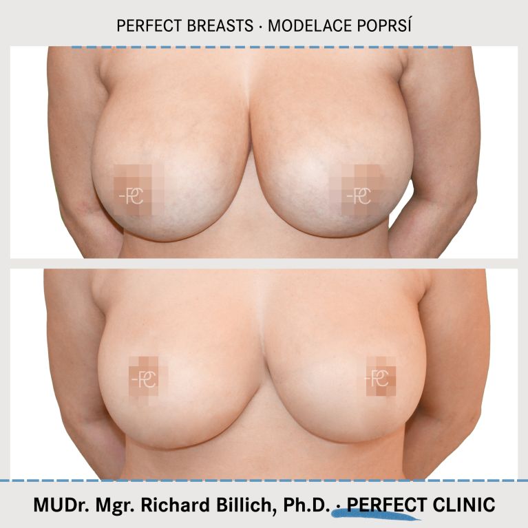 Modelace prsou