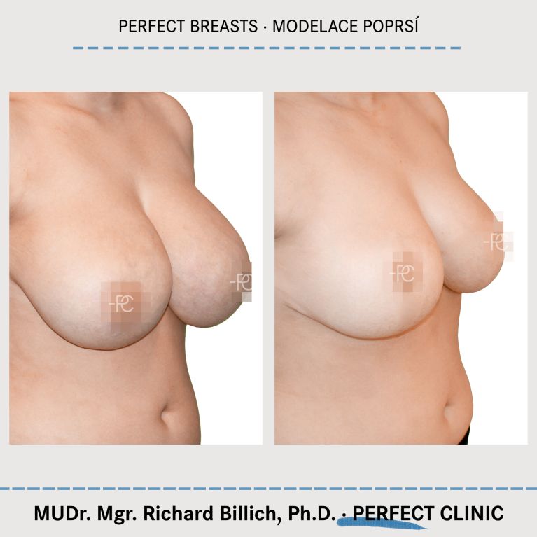 Modelace prsou