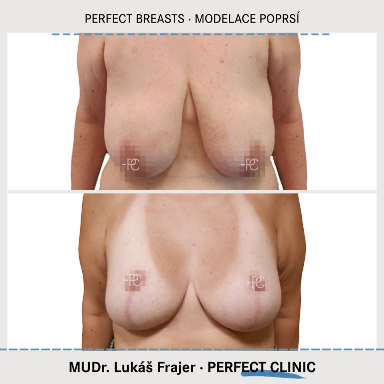 Modelace prsou
