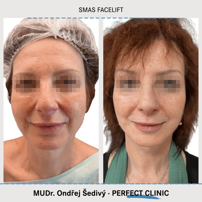 Facelift