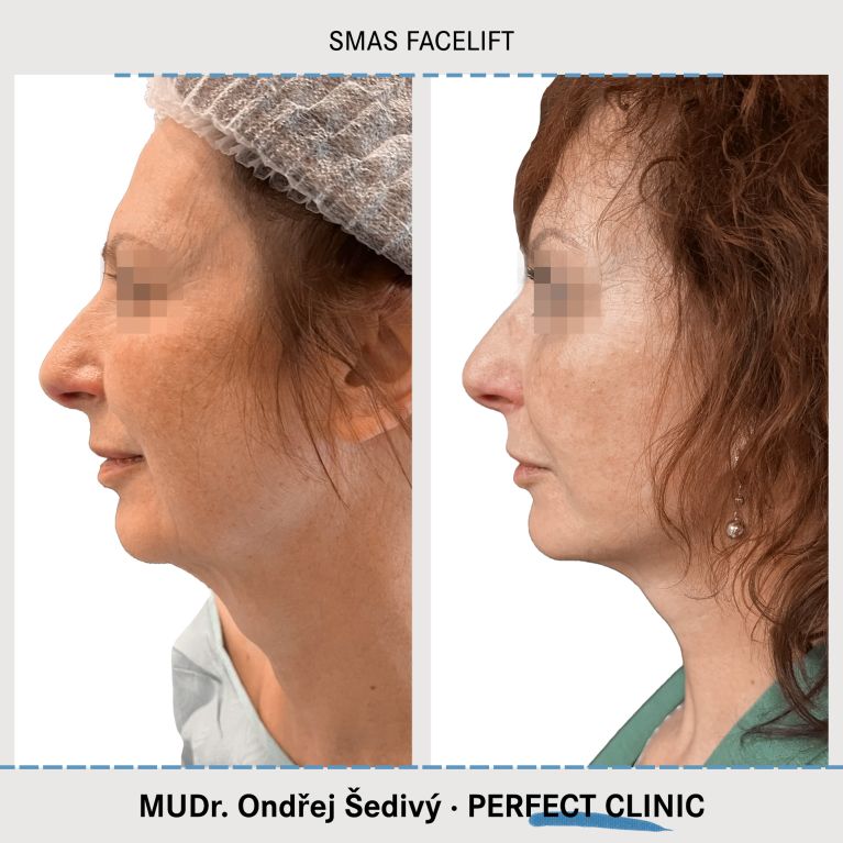 Facelift