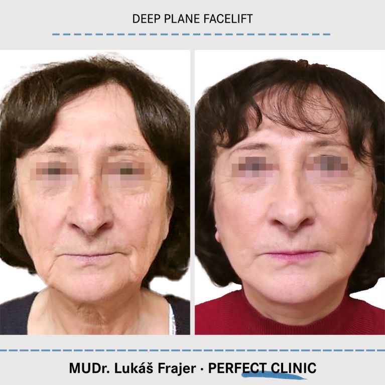 Facelift