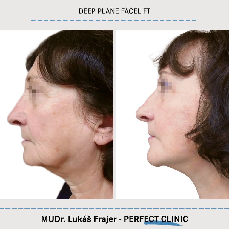 Facelift