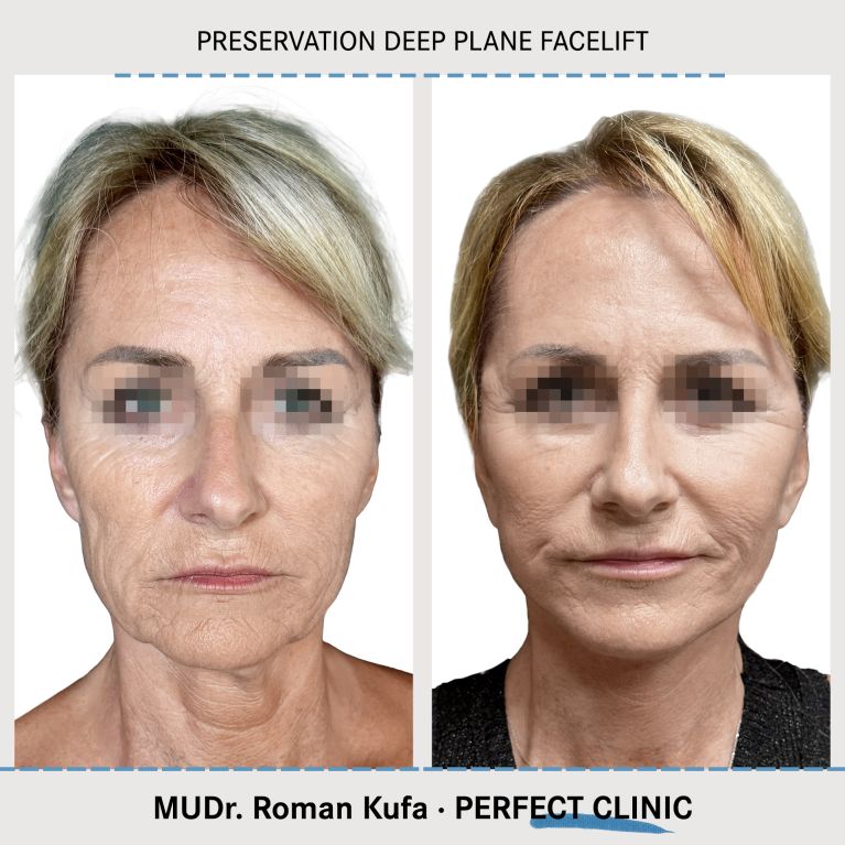 Facelift