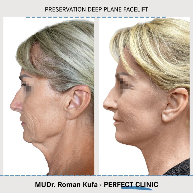 Facelift