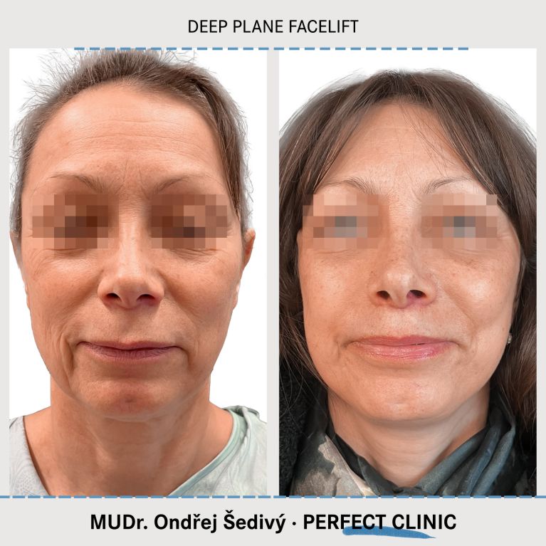 Facelift