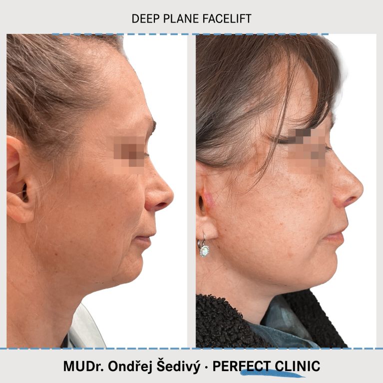 Facelift
