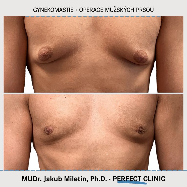 Gynekomastie