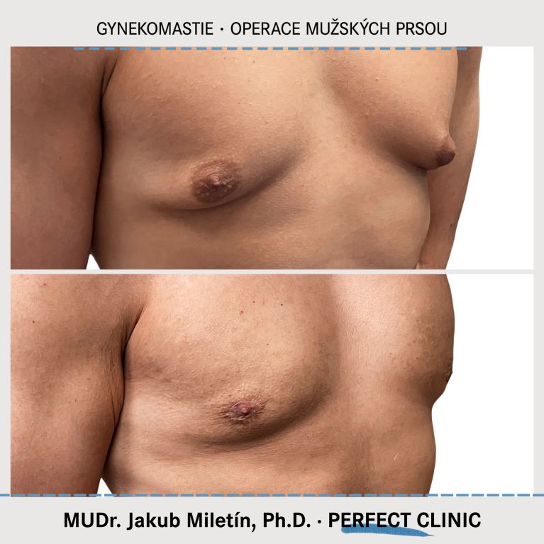 Gynekomastie
