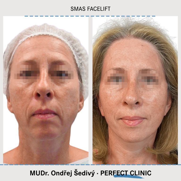 Facelift