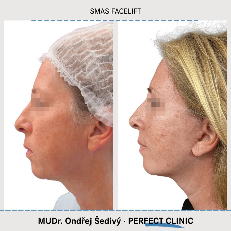 Facelift