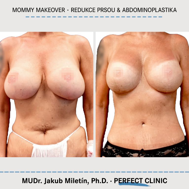 Mommy Makeover