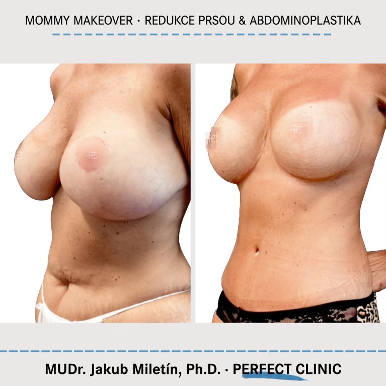 Mommy Makeover
