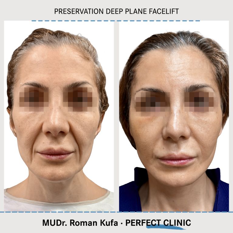 Facelift