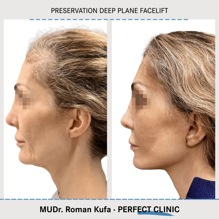 Facelift