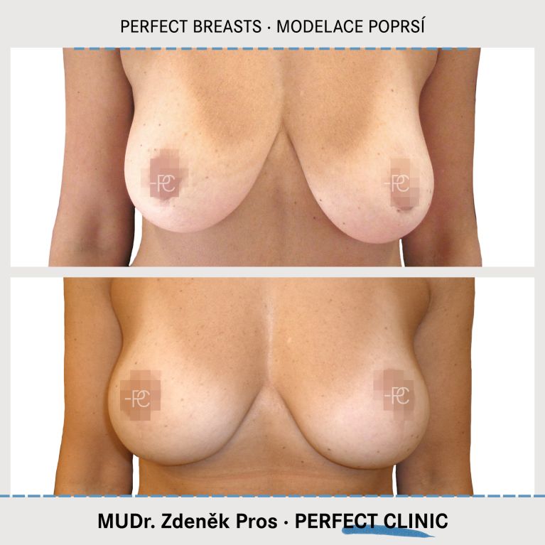 Modelace prsou