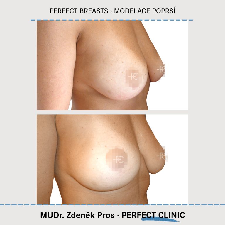Modelace prsou