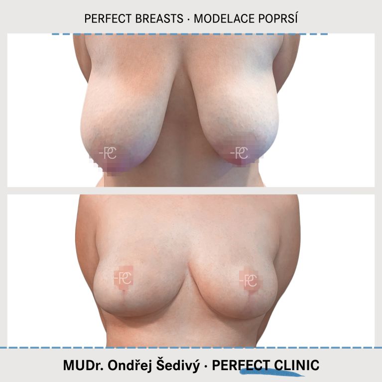 Modelace prsou