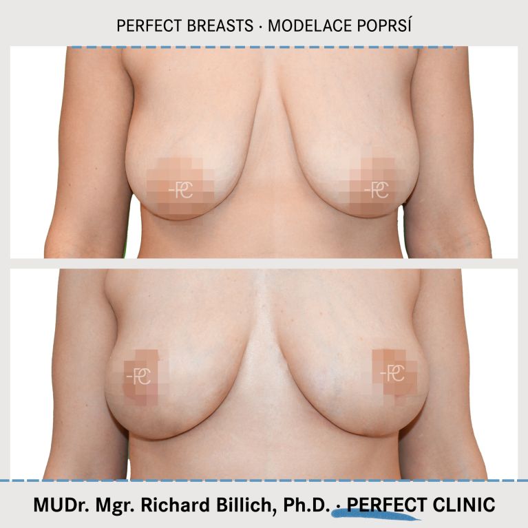 Modelace prsou