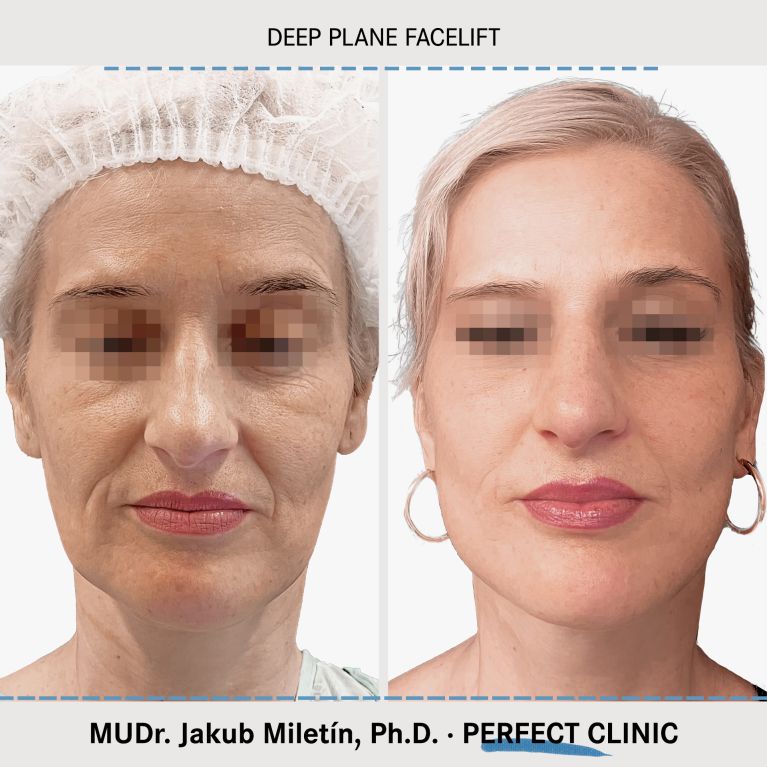 Facelift