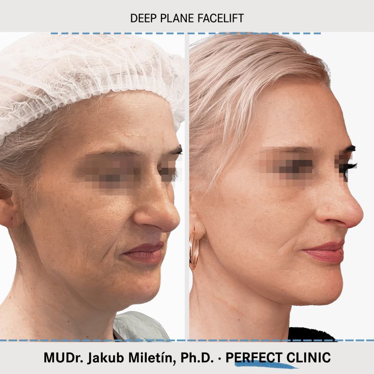 Facelift