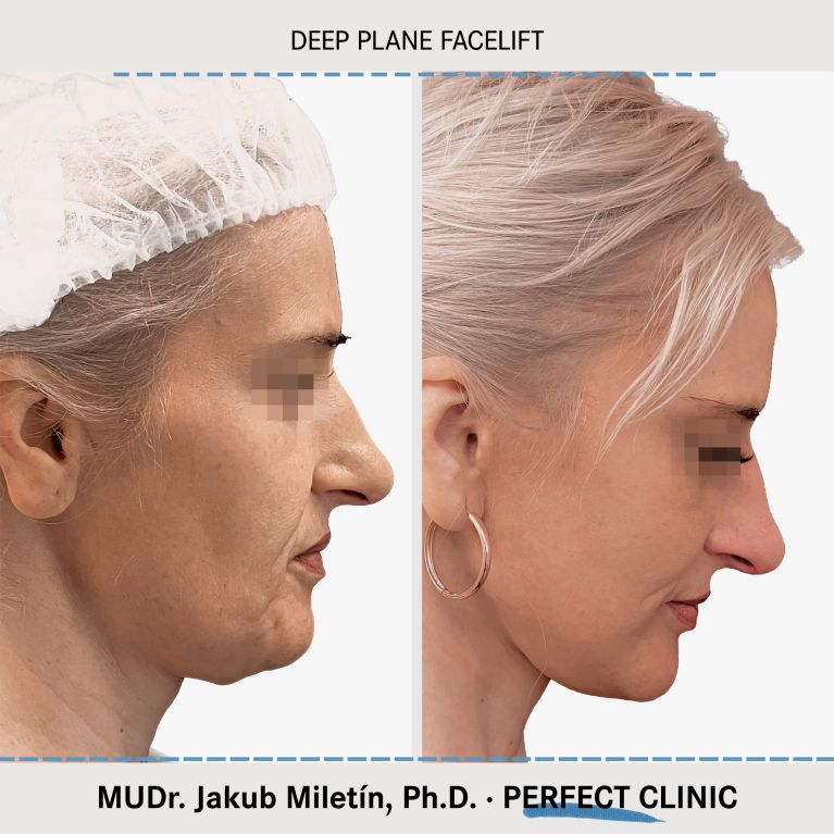 Facelift