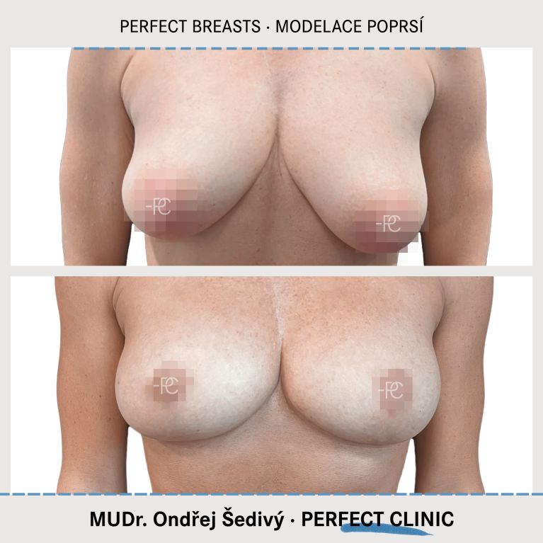 Modelace prsou