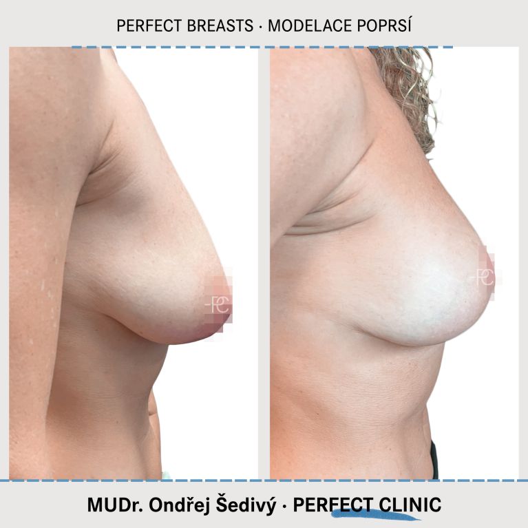 Modelace prsou