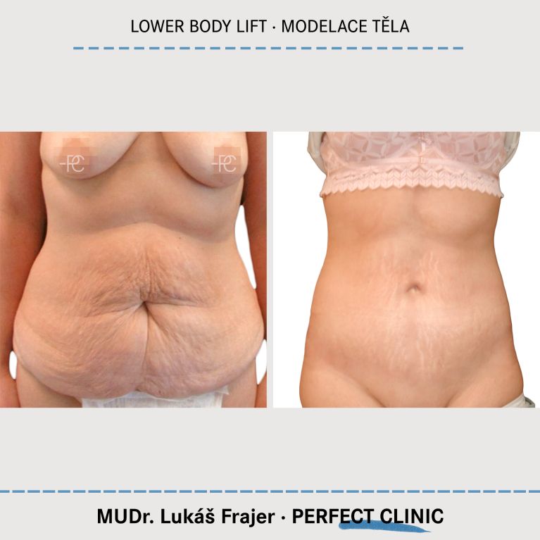 Body Sculpturing