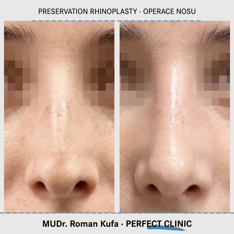 Rhinoplastika