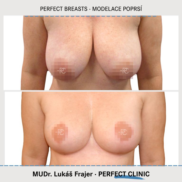 Modelace prsou