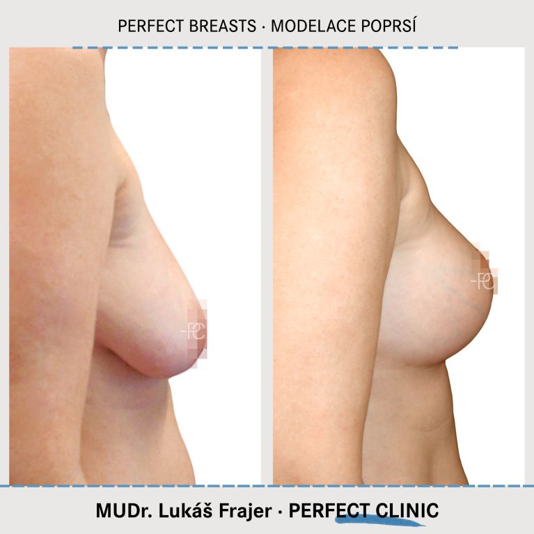 Modelace prsou