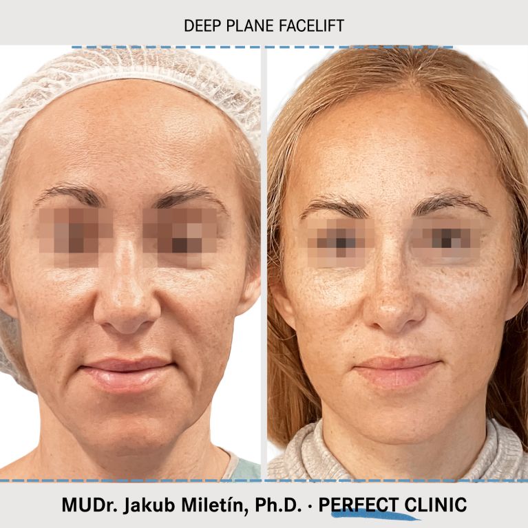 Facelift