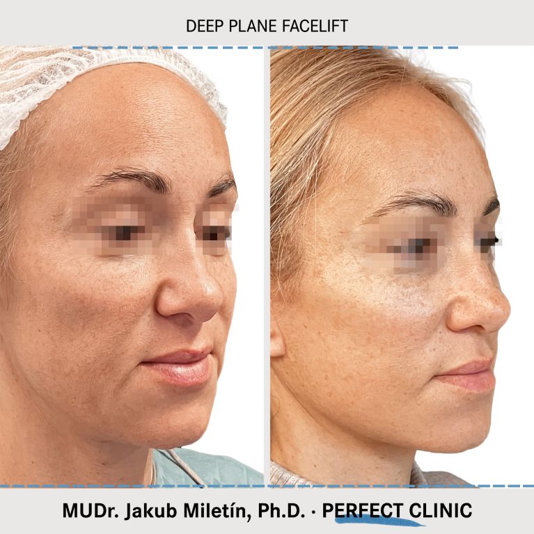 Facelift